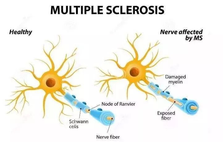 多发性硬化新疗法突破，带来治疗的新希望